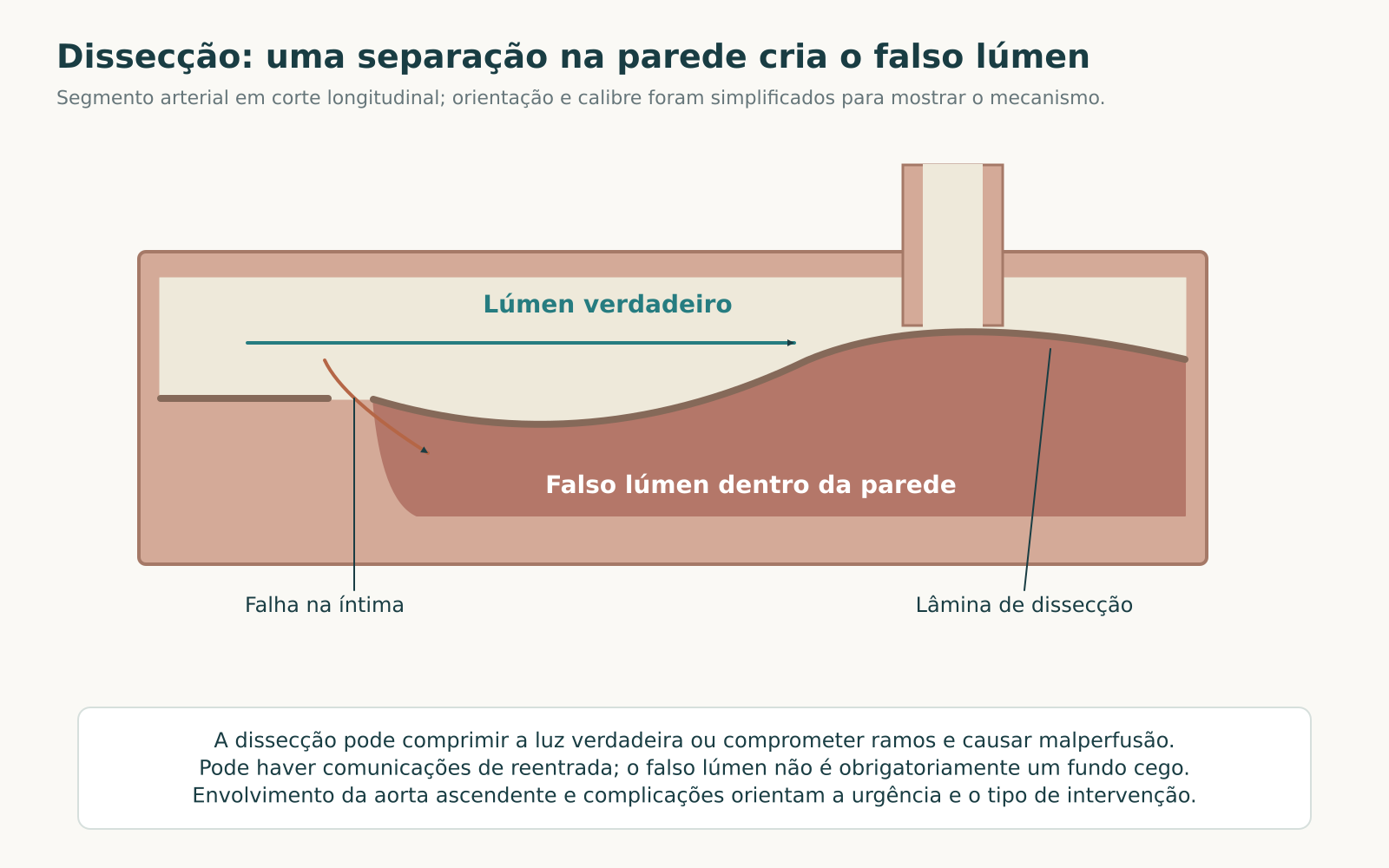 Esquema longitudinal de artéria com falha intimal, lâmina de dissecção, lúmen verdadeiro e falso lúmen formado dentro da parede.