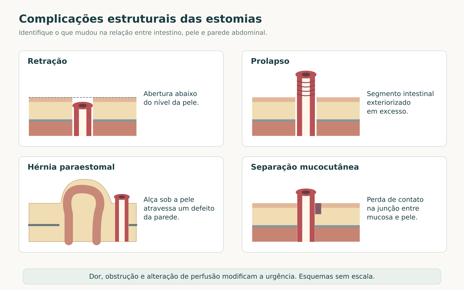 Quatro cortes esquemáticos mostrando retração, prolapso, hérnia paraestomal e separação mucocutânea.