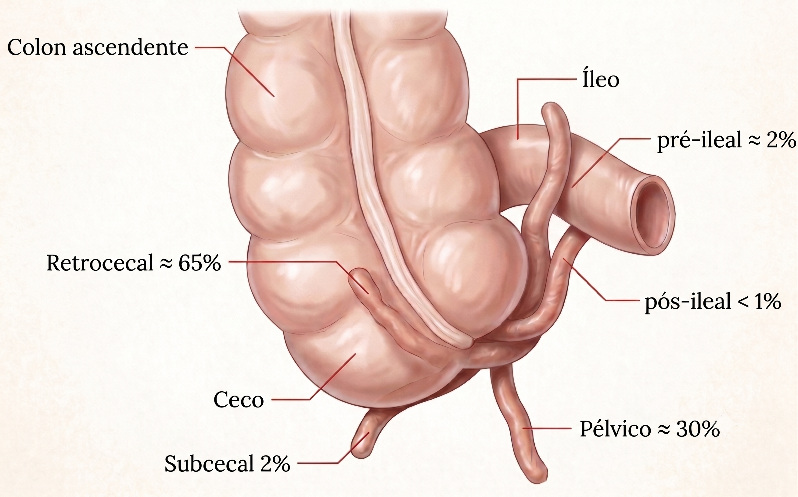 Diagrama composto com um ceco central e quatro posições possíveis do apêndice: retrocecal, pélvica, subcecal e retroileal, cada uma em tom diferente.