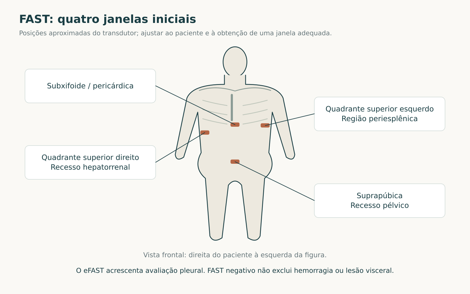 Silhueta anterior com quatro posições aproximadas do transdutor para as janelas pericárdica, hepatorrenal, periesplênica e suprapúbica do FAST.