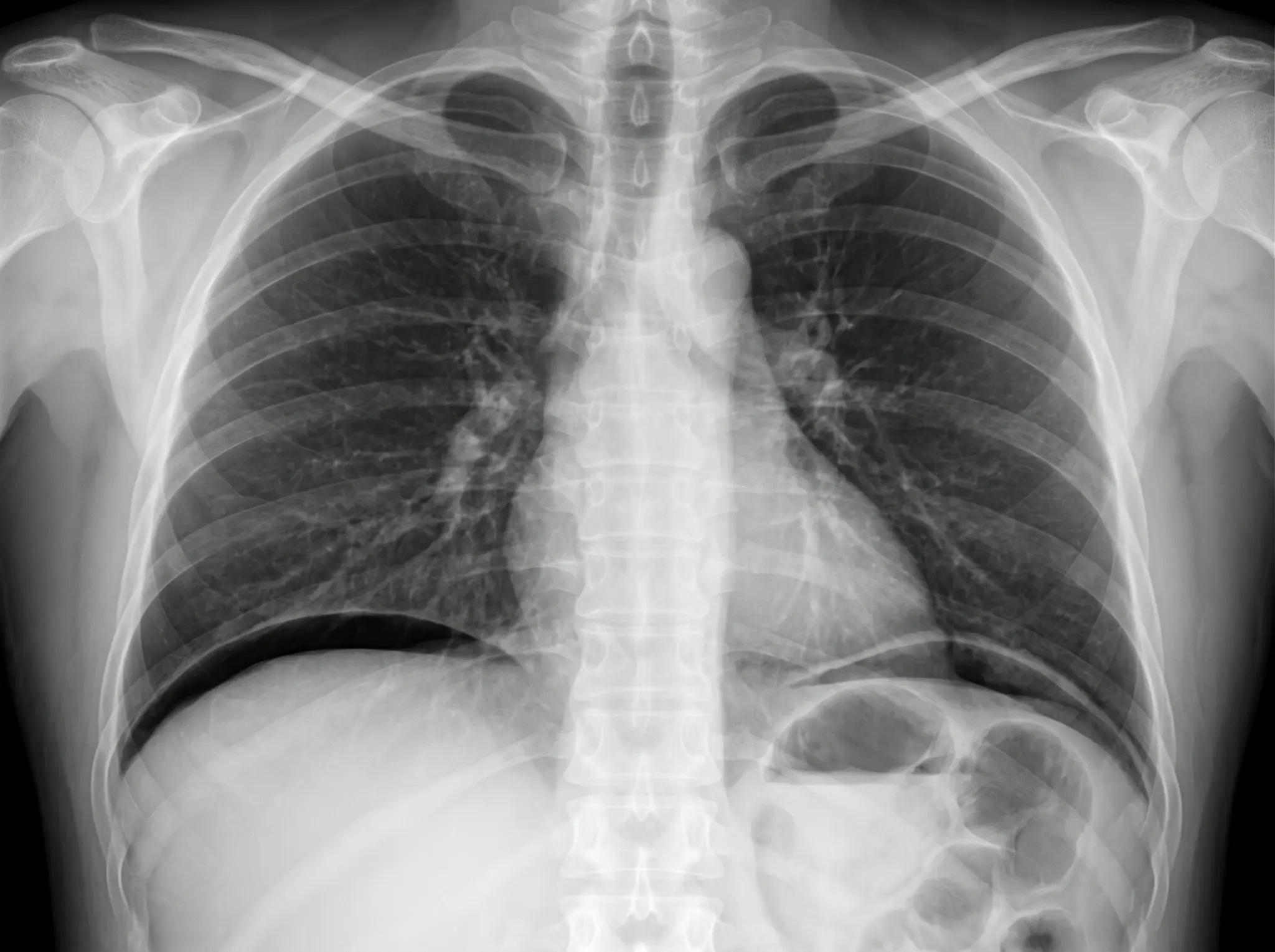Radiografia frontal de tórax em ortostase mostrando finas lâminas de ar livre sob os dois hemidiafragmas, mais evidentes à direita.