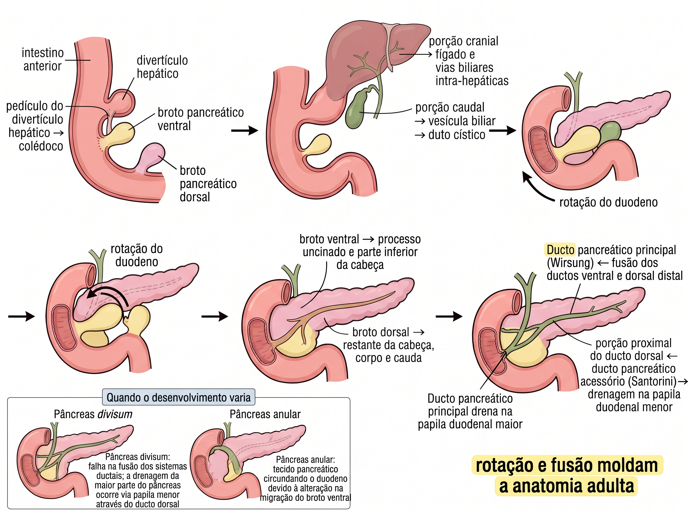 Infográfico sobre a embriologia das vias biliares e do pâncreas, mostrando o divertículo hepático, os brotos pancreáticos dorsal e ventral, a rotação e fusão dos brotos, a formação dos ductos de Wirsung e Santorini e as alterações que originam pâncreas divisum e pâncreas anular.