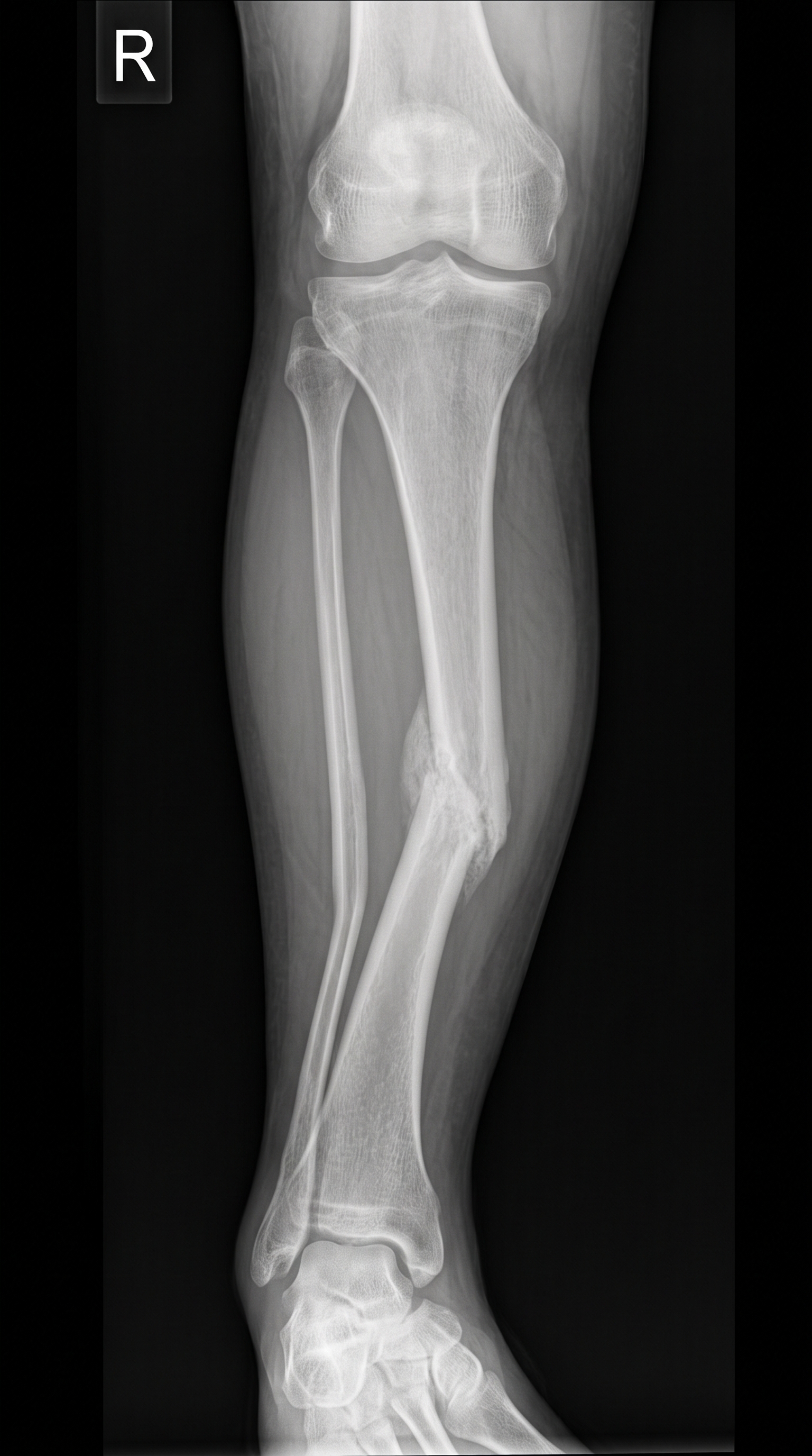 Radiografia sintética AP da perna direita mostrando tíbia e fíbula consolidadas com deformidade angular diafisária.