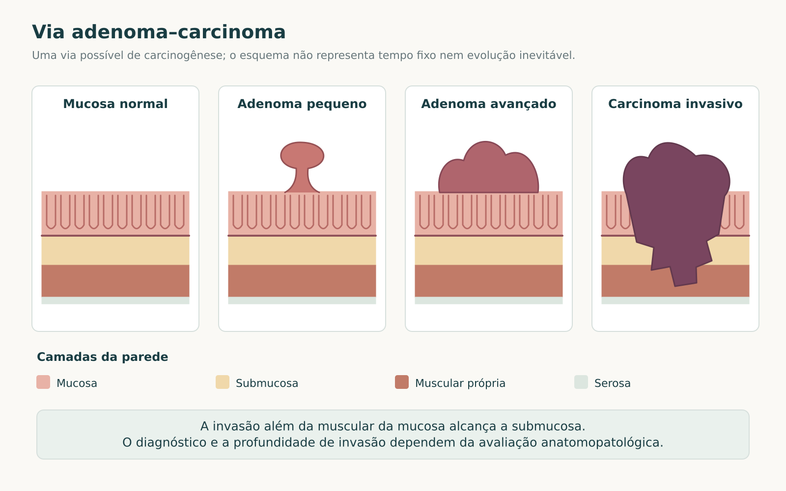 Esquema da via adenoma-carcinoma com mucosa normal, adenoma pequeno, adenoma avançado e invasão das camadas da parede.