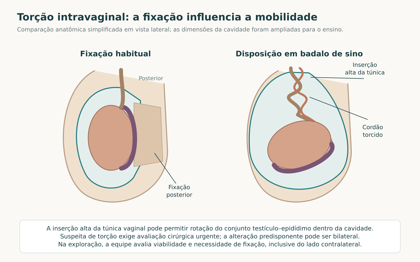 Dois esquemas laterais com fixação posterior habitual e disposição em badalo de sino: túnica vaginal de inserção alta, testículo rodado e cordão torcido.