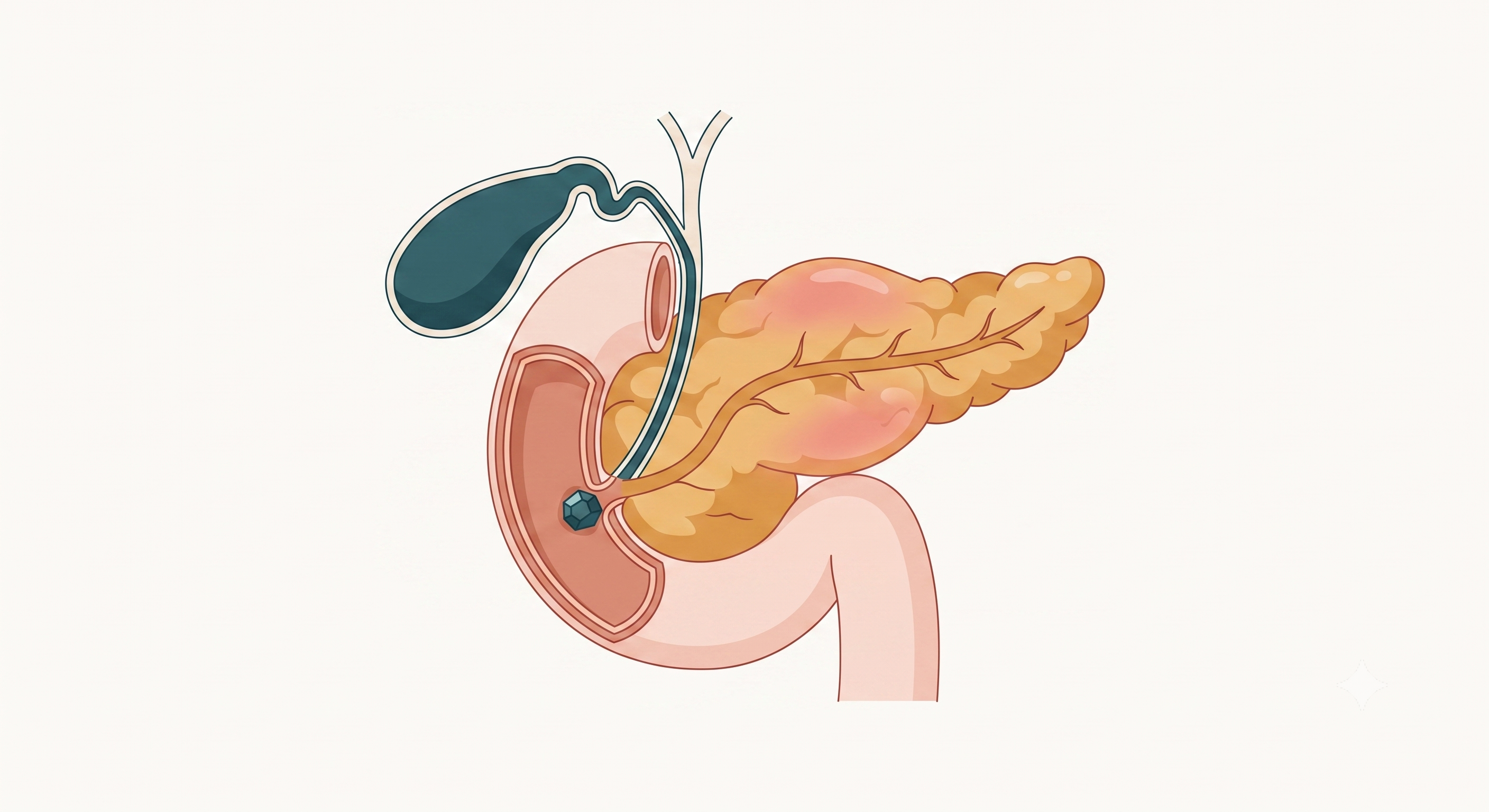 Corte anatômico esquemático mostrando um cálculo impactado na ampola de Vater, no ponto de junção do colédoco com o ducto pancreático, e o pâncreas edemaciado logo atrás.