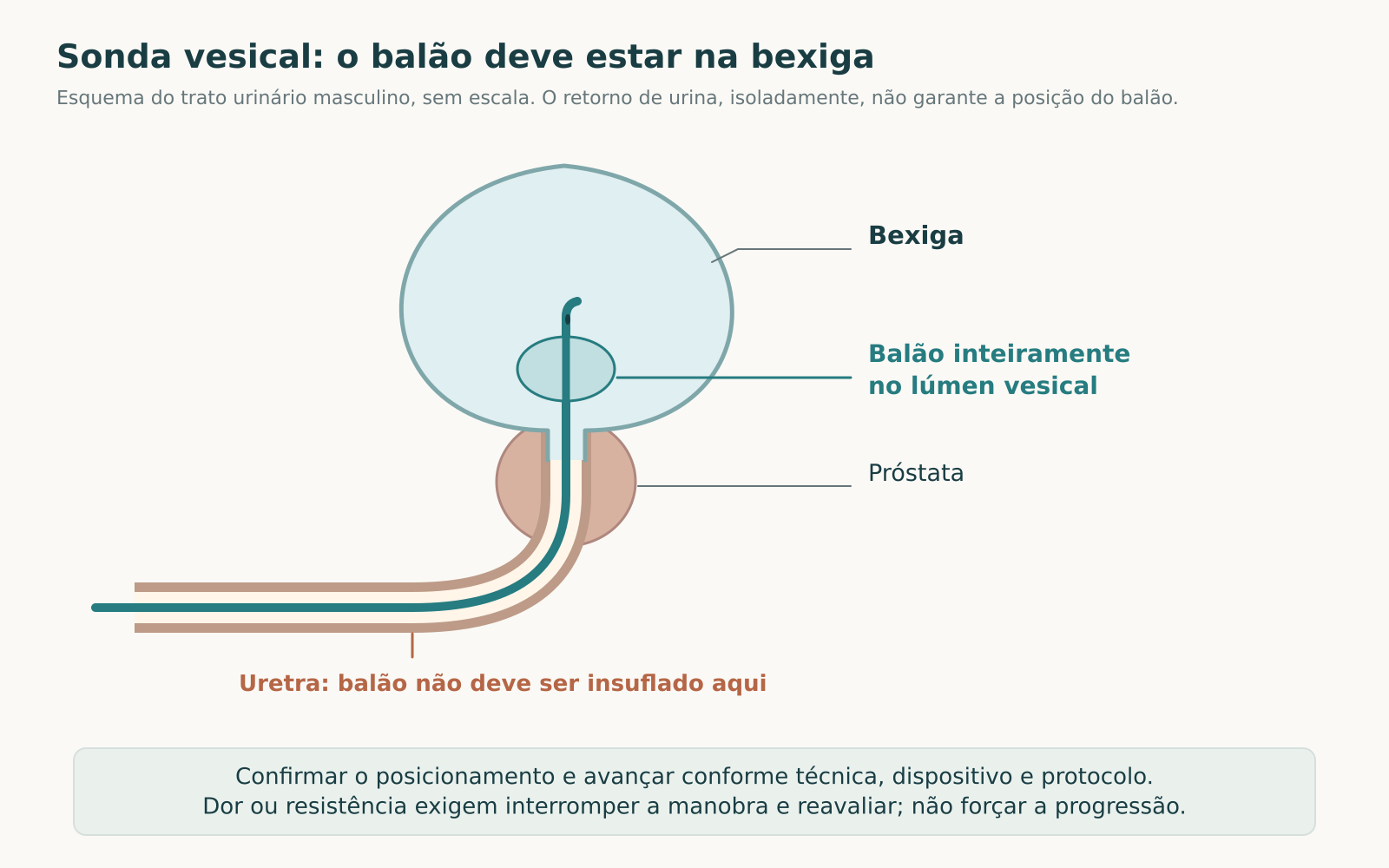 Esquema do trato urinário masculino com sonda contínua pela uretra, balão e ponta inteiramente dentro da bexiga e próstata identificada.