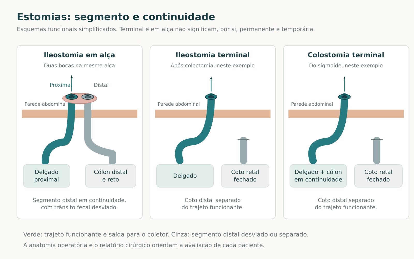 Esquemas funcionais de ileostomia em alça com duas bocas, ileostomia terminal após colectomia e colostomia terminal do sigmoide com coto retal fechado.