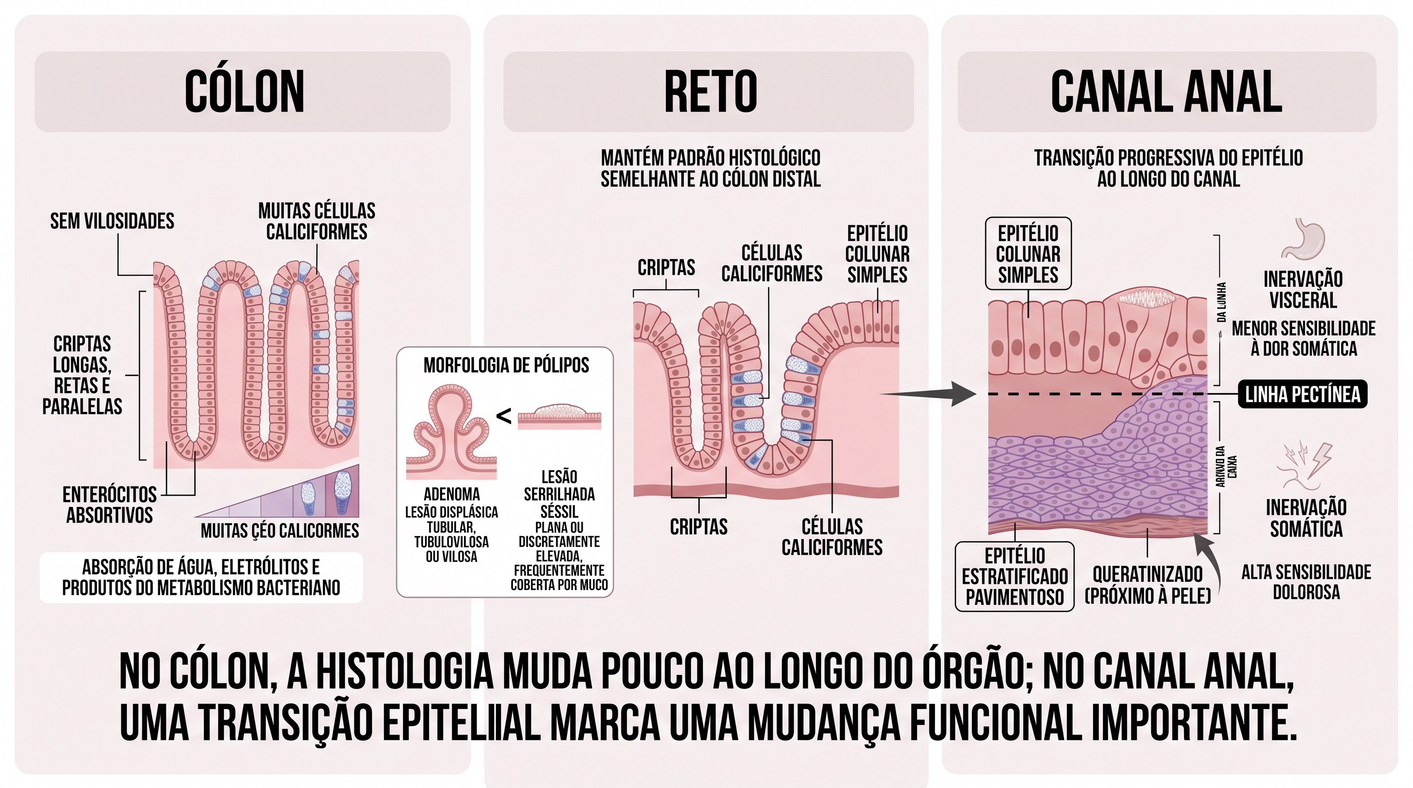 Infográfico histológico do cólon, reto e canal anal, mostrando mucosa colônica sem vilosidades, com criptas retas, enterócitos e numerosas células caliciformes, a manutenção desse padrão no reto, a morfologia de adenomas e lesões serrilhadas sésseis e a transição epitelial do canal anal em relação à linha pectínea.