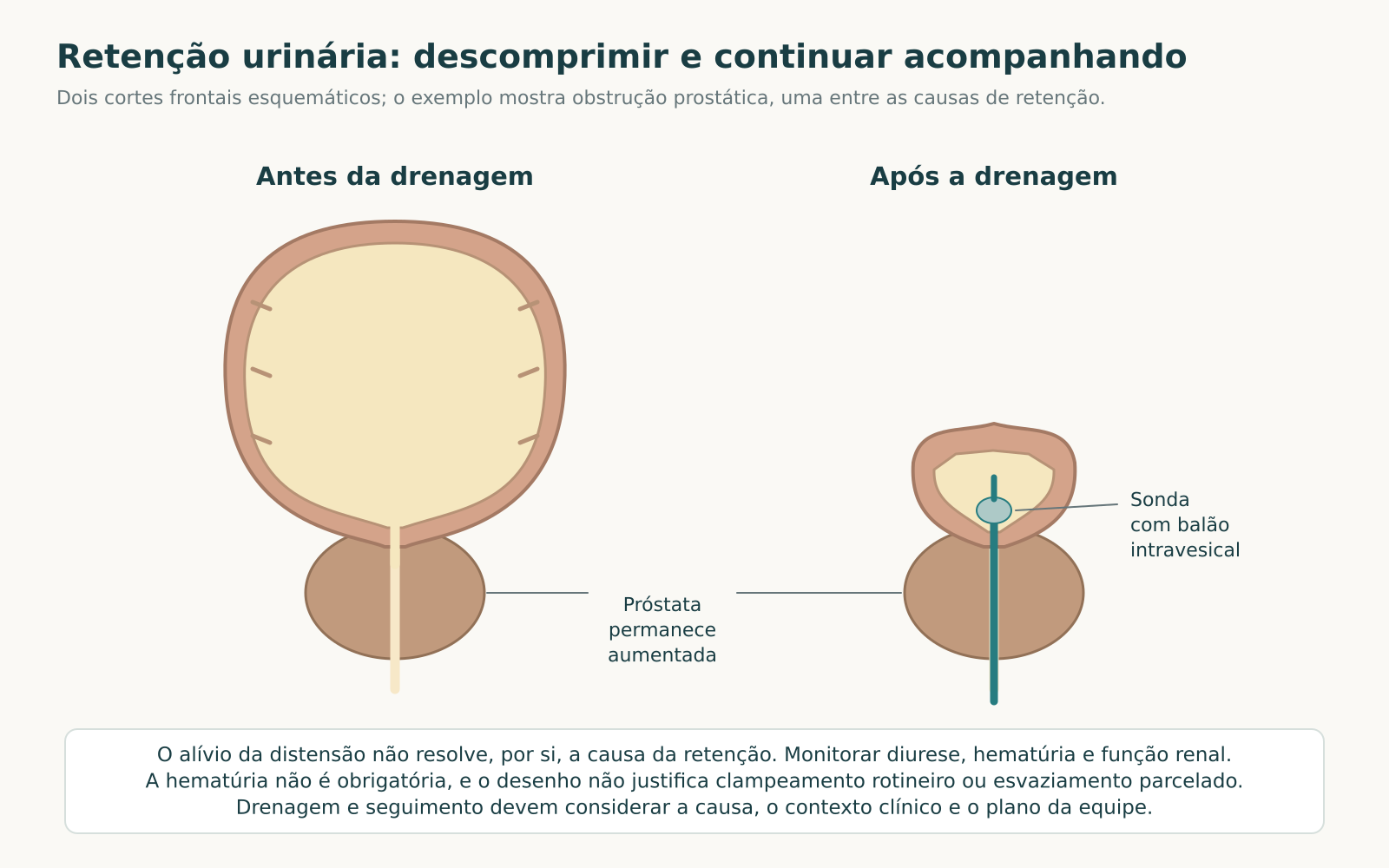 Dois esquemas frontais de bexiga antes e após a drenagem por sonda, com redução da distensão e manutenção do volume prostático; balão dentro da bexiga.