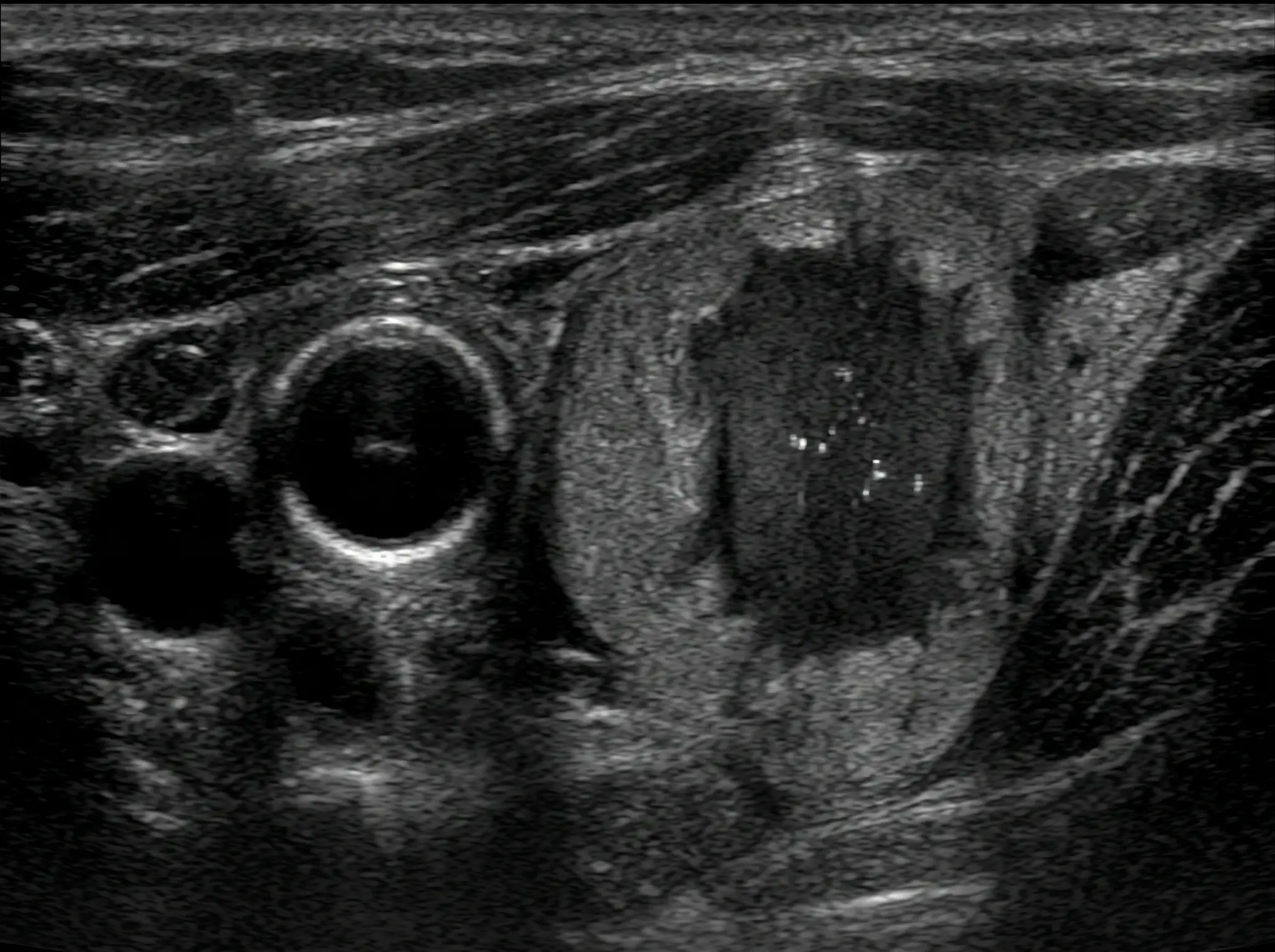 Ultrassonografia transversal da tireoide mostrando nódulo sólido hipoecoico, mais alto que largo, de margens irregulares e com focos ecogênicos puntiformes.