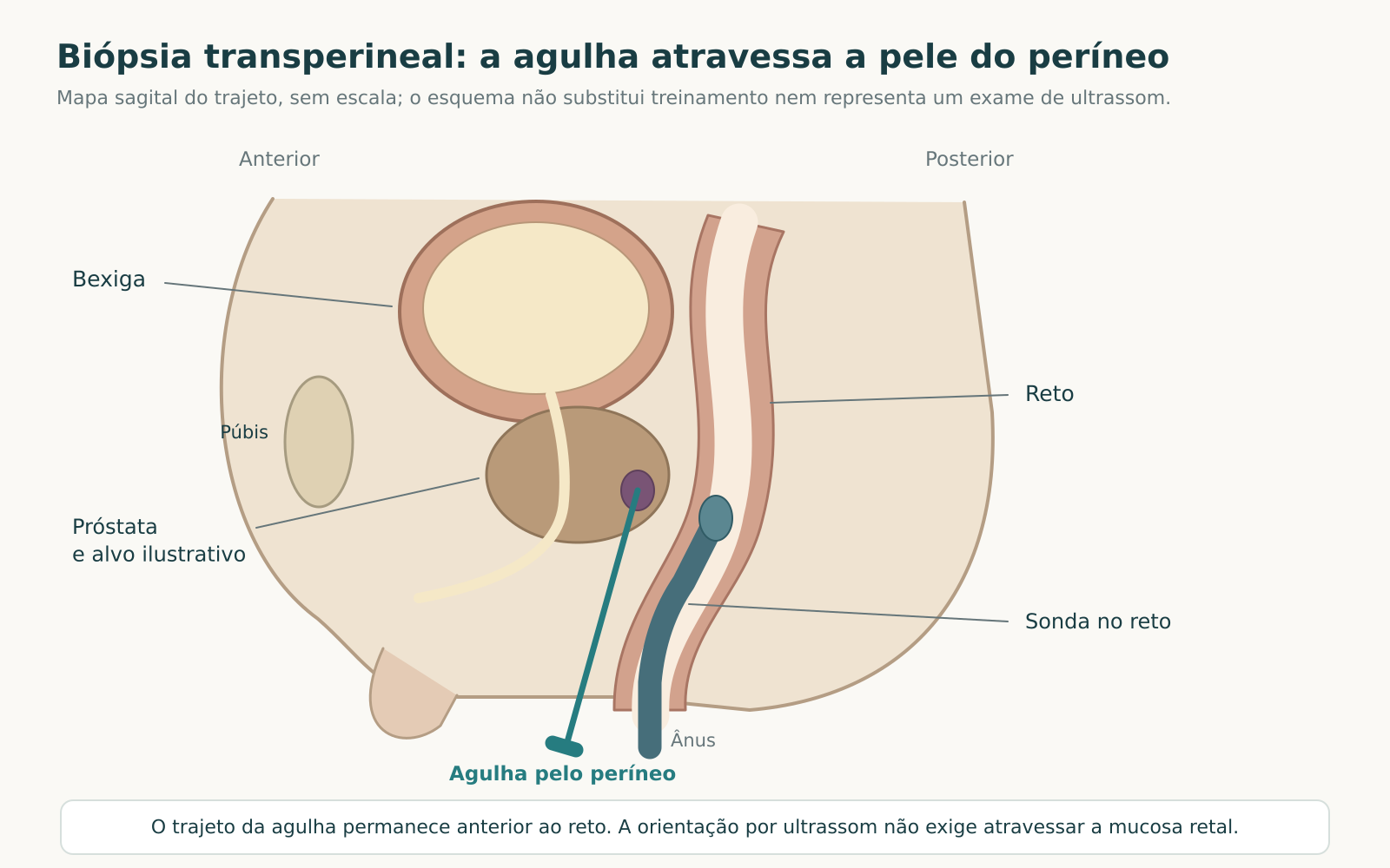 Mapa sagital da pelve com bexiga, próstata, reto e púbis, sonda dentro do reto e agulha que entra pelo períneo até um alvo prostático.