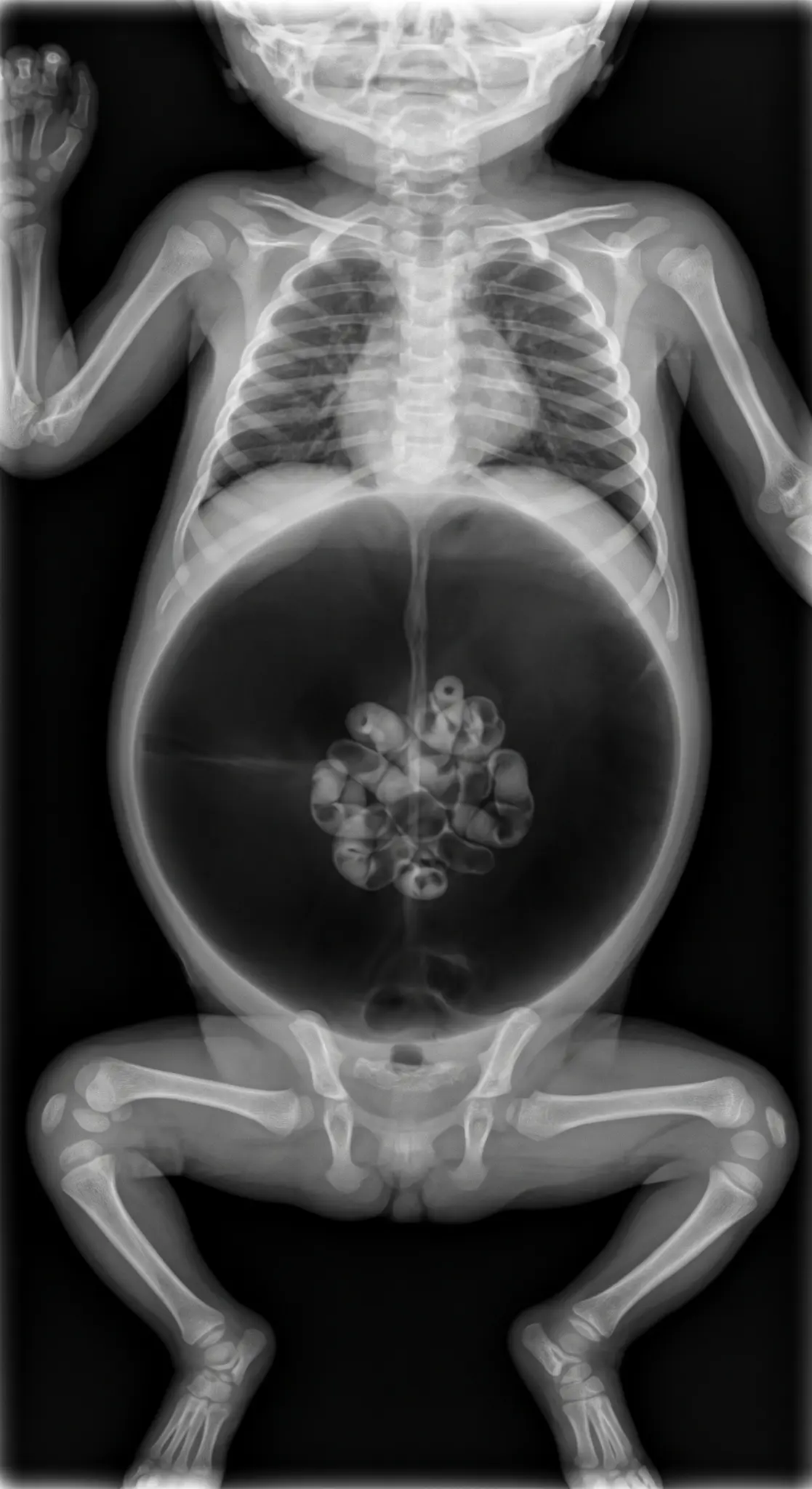 Radiografia AP supina pediátrica mostrando pneumoperitônio volumoso, ligamento falciforme delineado e alças agrupadas no centro — sinal do futebol.