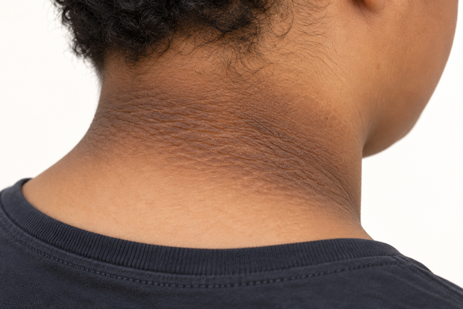 Nuca e lateral do pescoço de um adolescente com obesidade, com uma faixa de pele escurecida, espessa e aveludada acompanhando as dobras.