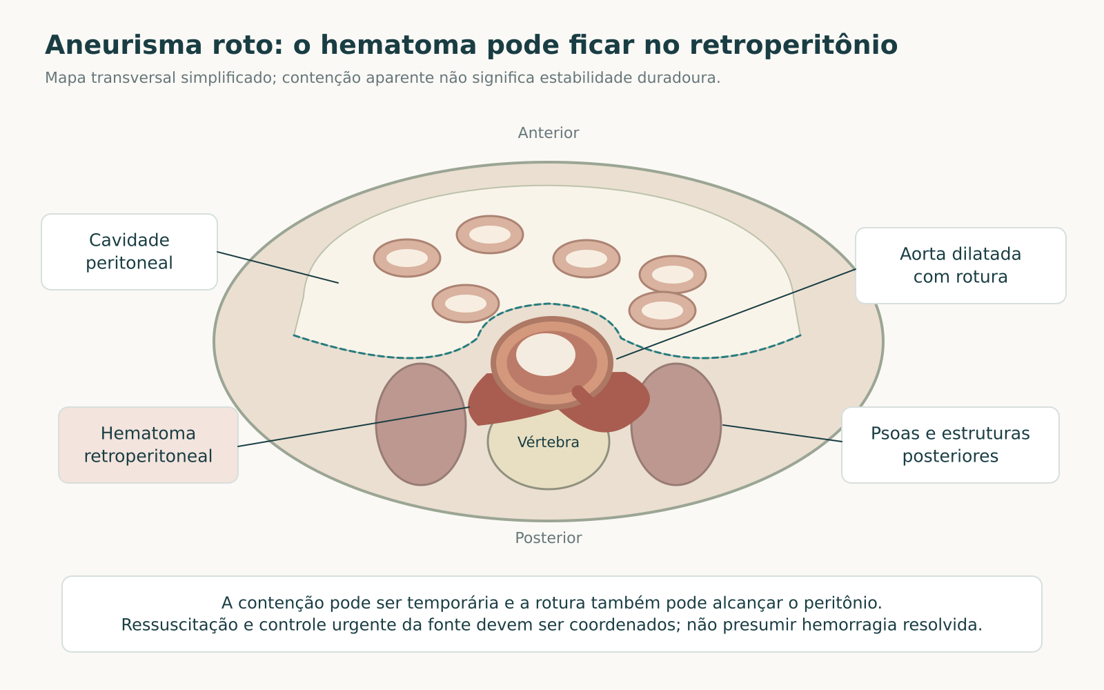 Mapa transversal do abdome com aneurisma da aorta roto, hematoma retroperitoneal, psoas, vértebra e cavidade peritoneal anterior.