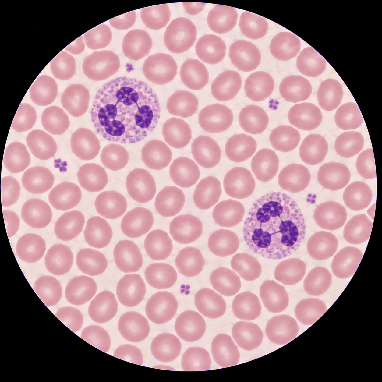 Campo microscópico ilustrativo com hemácias e dois neutrófilos; não diagnostica linfopenia.