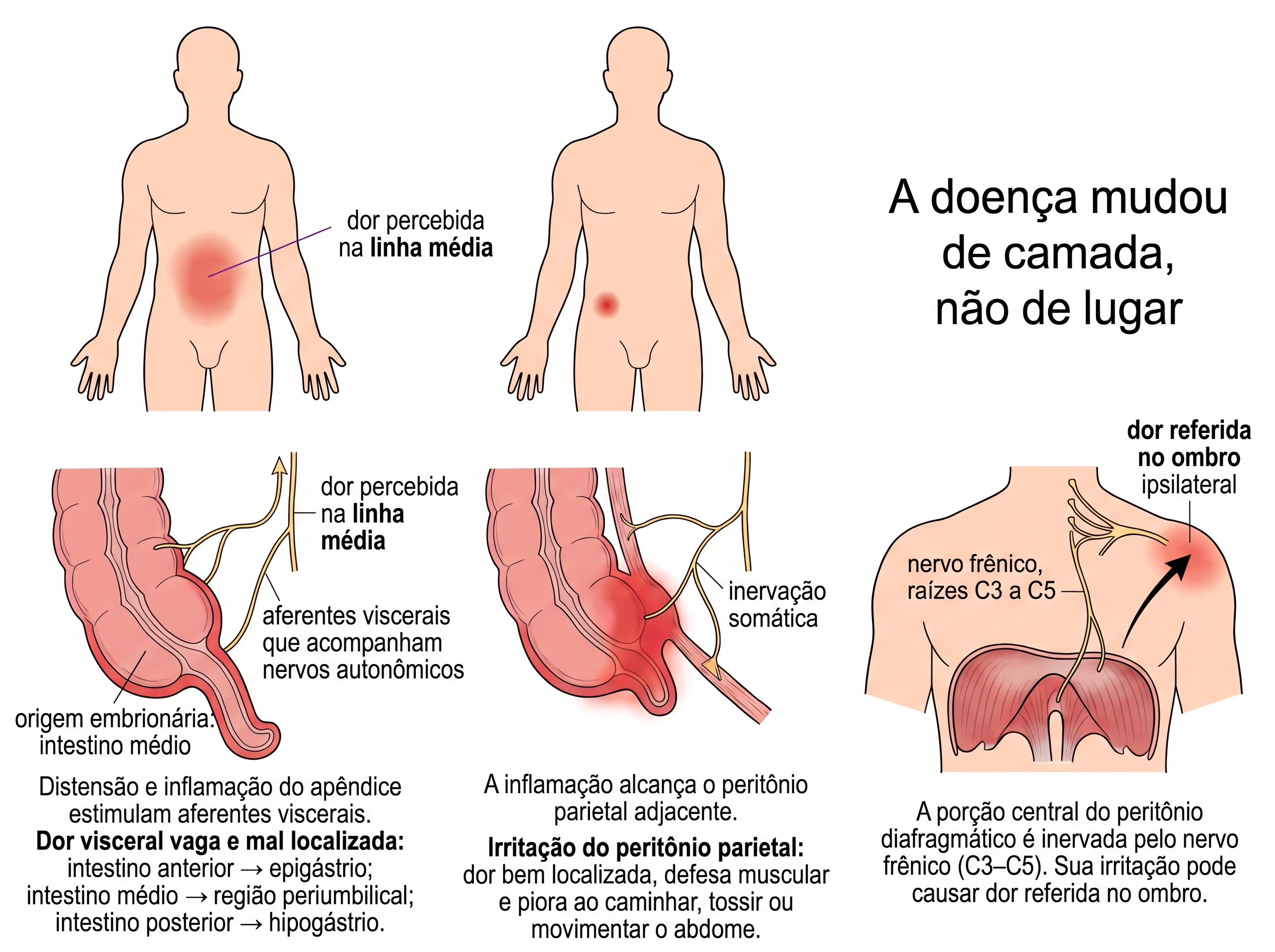 Linha do tempo da dor da apendicite: fase visceral vaga periumbilical, fase parietal localizada na fossa ilíaca direita e o desvio do frênico ao ombro.