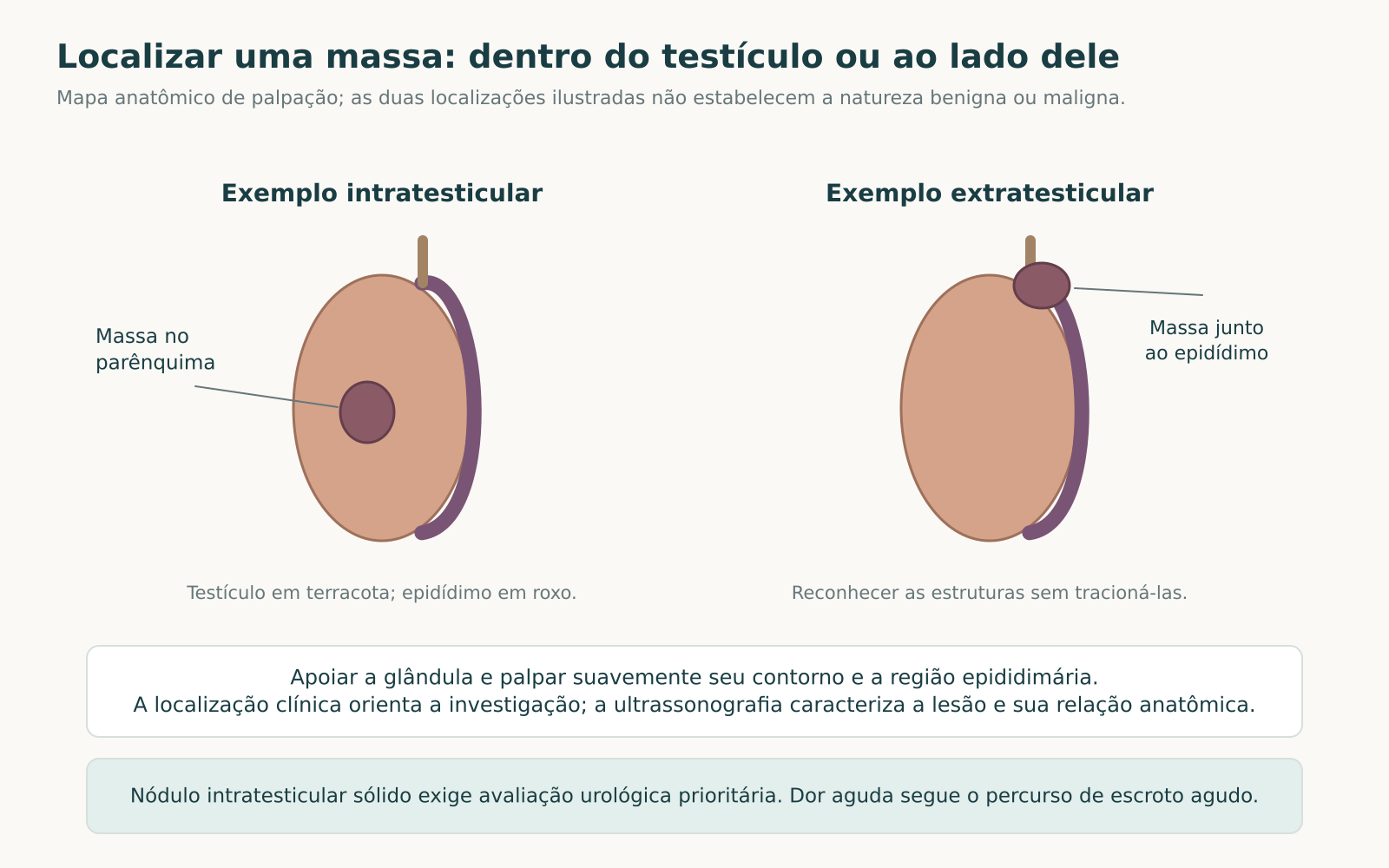 Mapa anatômico com testículo e epidídimo contíguos; à esquerda, massa dentro do parênquima e, à direita, massa junto à cabeça do epidídimo.