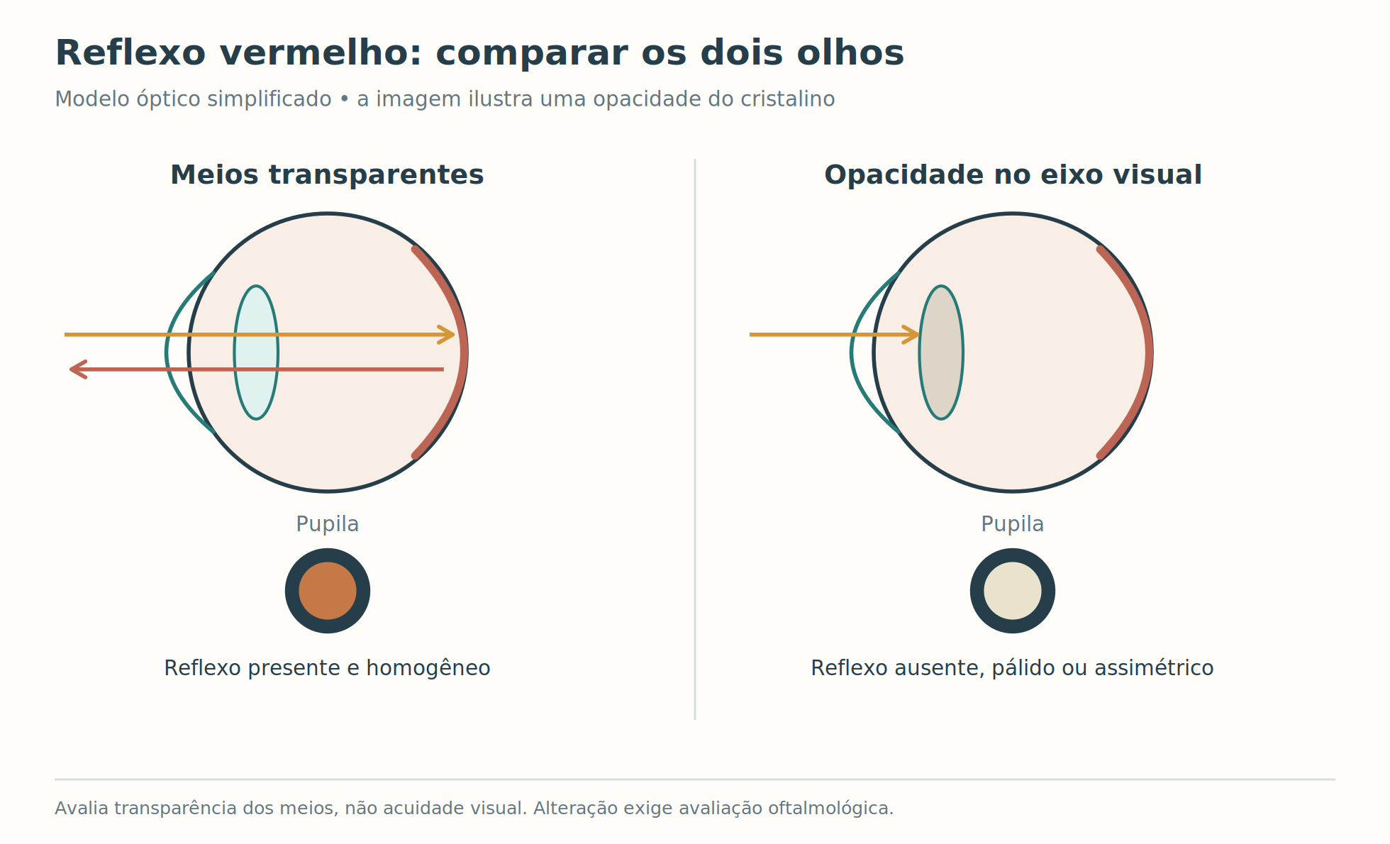 Dois esquemas ópticos do olho com passagem da luz e bloqueio por opacidade do cristalino.