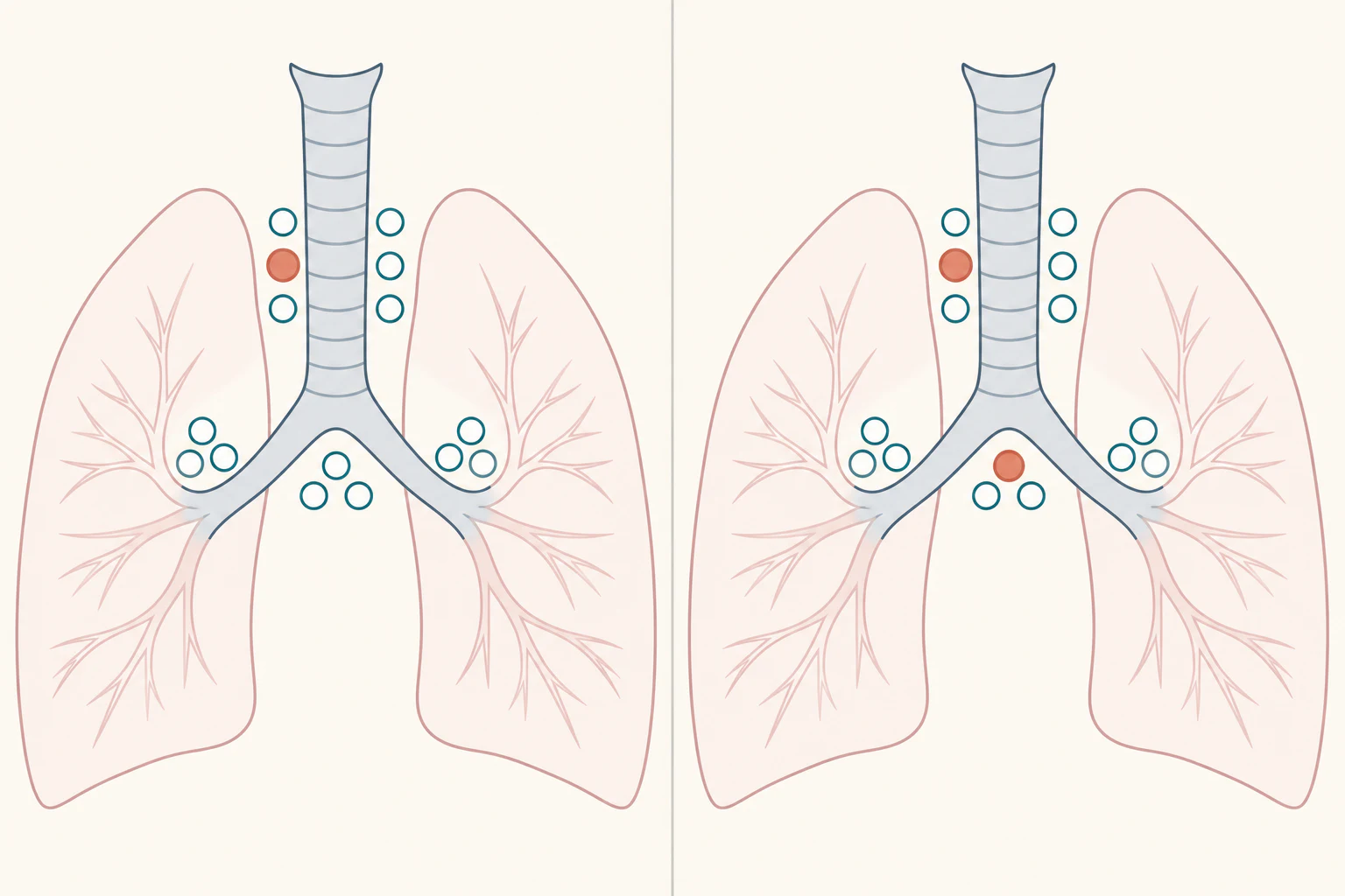 Esquema do mediastino em corte coronal mostrando traqueia, carina e os dois brônquios principais, com linfonodos hilares e mediastinais representados como círculos: à esquerda um único círculo mediastinal marcado, à direita dois círculos mediastinais marcados em estações diferentes.