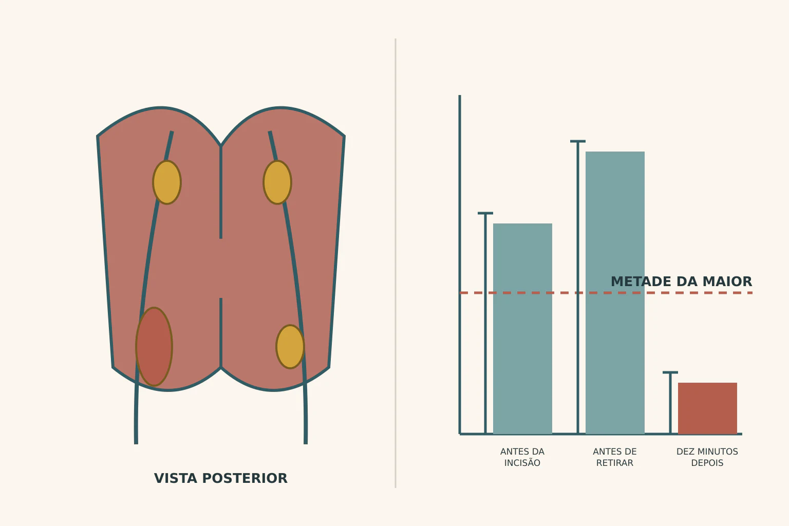 Vista posterior da tireoide com quatro paratireoides, uma aumentada, e nervo ascendente rente às inferiores; ao lado, gráfico com três barras de dosagem hormonal e linha tracejada na metade da barra mais alta.