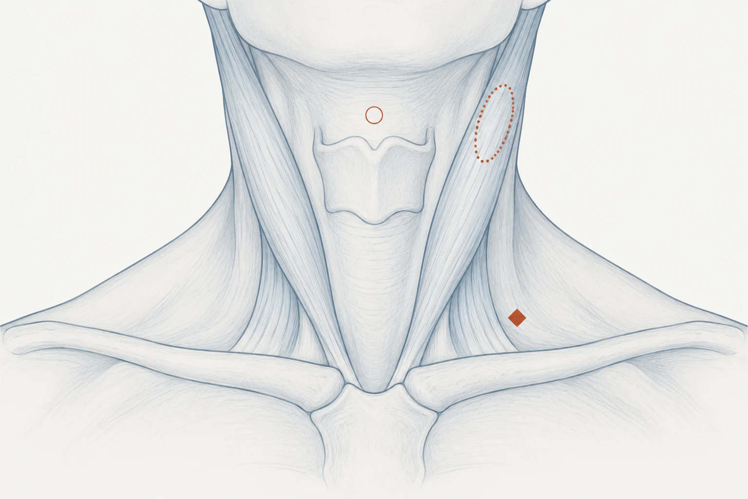 Esquema do pescoço em vista anterior, sem rosto, com três posições de massa cervical: marca circular na linha média acima da cartilagem tireóidea, marca ovalada sobre a borda anterior do esternocleidomastóideo esquerdo no terço superior, e marca no fundo da fossa supraclavicular do mesmo lado.