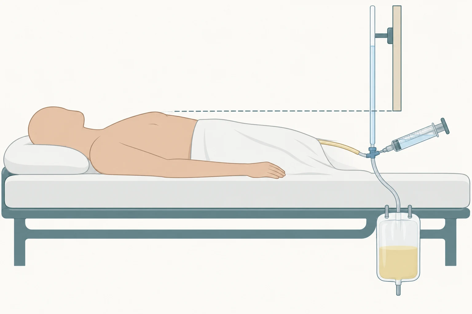 Paciente deitado completamente plano no leito, com sonda vesical ligada a um sistema coletor fechado, seringa instilando pequeno volume de solução por um portal lateral e coluna líquida vertical ao lado de uma régua cuja marca inferior é alinhada por uma linha tracejada horizontal à linha axilar média do tórax.