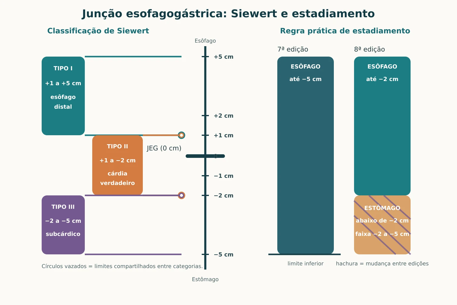 Régua vertical de 5 cm acima a 5 cm abaixo da junção esofagogástrica. À esquerda, as faixas de Siewert: tipo I de 1 a 5 cm acima, tipo II de 1 cm acima a 2 cm abaixo, tipo III de 2 a 5 cm abaixo, com marcas nos dois pontos de encosto, exatamente 1 cm acima e exatamente 2 cm abaixo. À direita, duas barras de estadiamento: a da 7ª edição trata como esôfago até 5 cm abaixo; a da 8ª, só até 2 cm abaixo, e o trecho de 2 a 5 cm abaixo aparece hachurado como estômago.