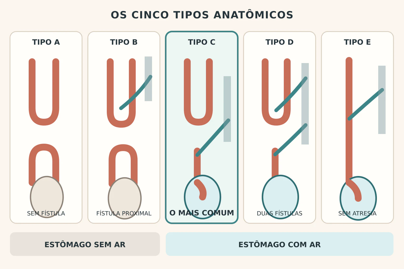 Esquema dos cinco tipos anatômicos de atresia de esôfago, do tipo A ao tipo E, mostrando em cada um a posição do coto esofágico superior e inferior, a presença ou ausência de fístula com a traqueia e se o estômago aparece com ou sem ar.