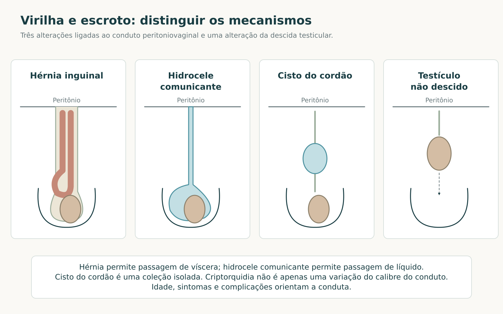 Quatro esquemas com hérnia inguinal, hidrocele comunicante, cisto de cordão e testículo não descido.