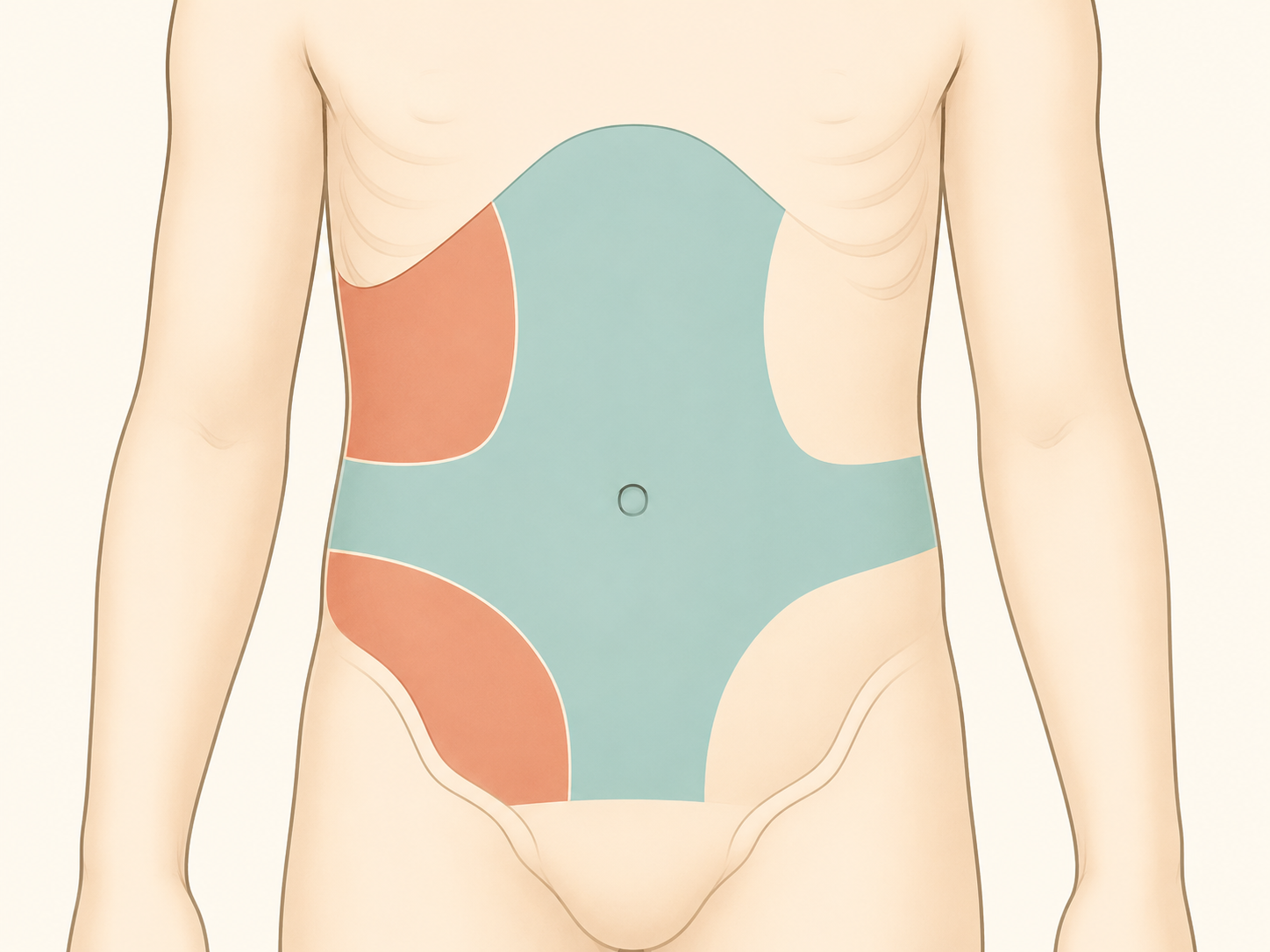 Contorno esquemático de um abdome infantil visto de frente, com a região em volta do umbigo e o epigástrio sombreados de um tom e os quadrantes superior direito e inferior direito sombreados de outro.