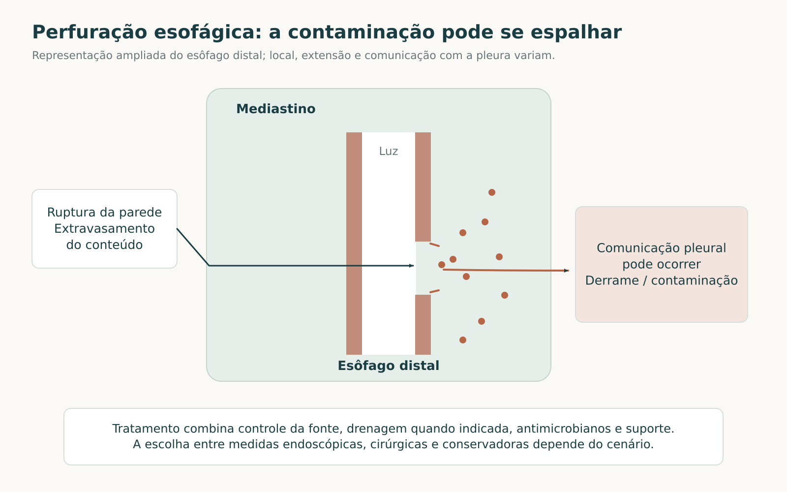 Corte esquemático do esôfago distal com ruptura da parede, extravasamento para o mediastino e indicação de possível comunicação com a pleura.