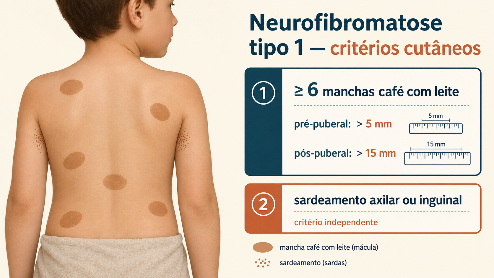 Tronco infantil com seis manchas café com leite de bordas regulares e sardeamento axilar, ao lado dos critérios de número e tamanho da neurofibromatose tipo 1.