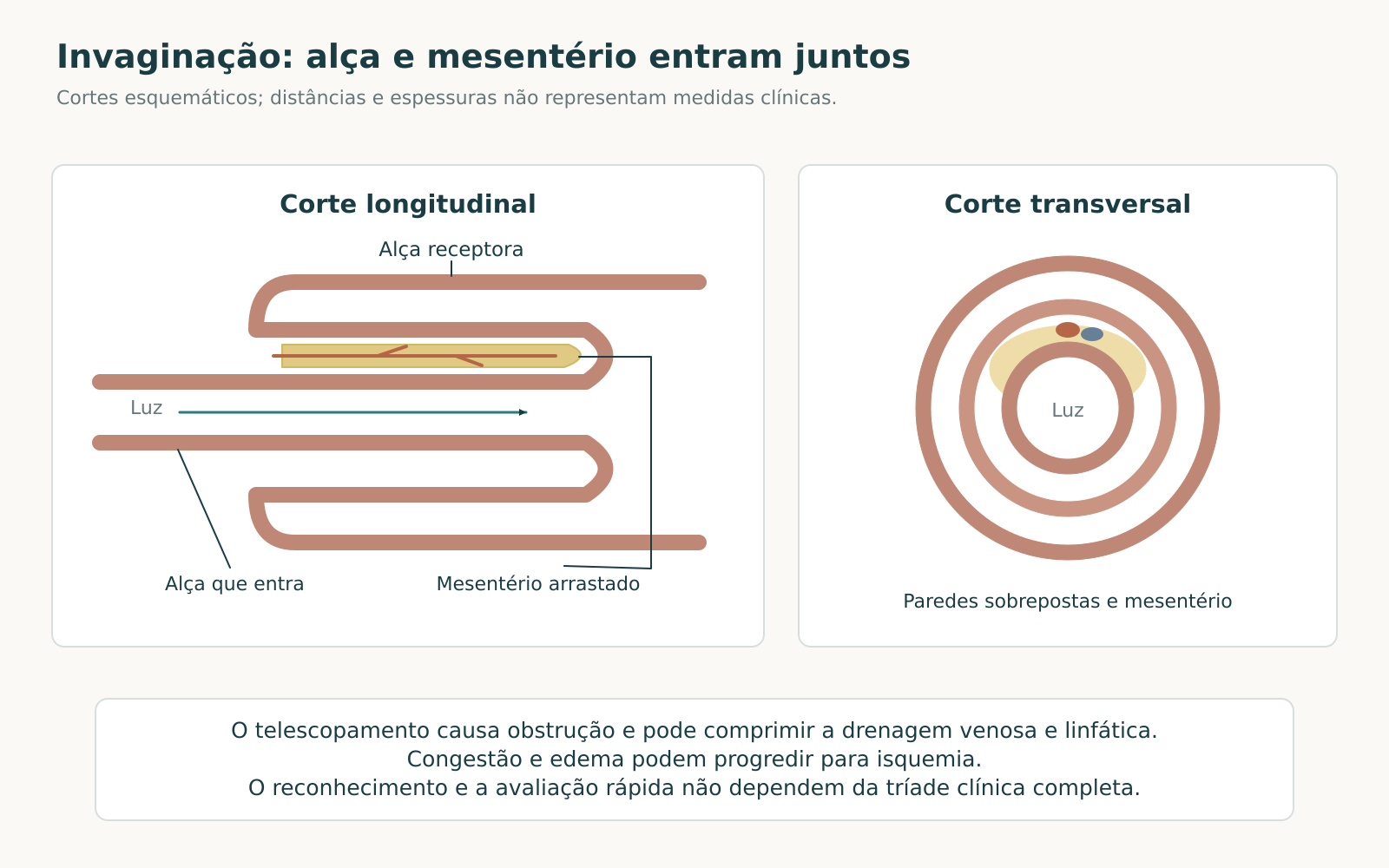 Esquema em dois painéis da invaginação intestinal: uma alça penetra em outra, arrastando mesentério e vasos; o corte transversal mostra três camadas de parede e mesentério excêntrico.