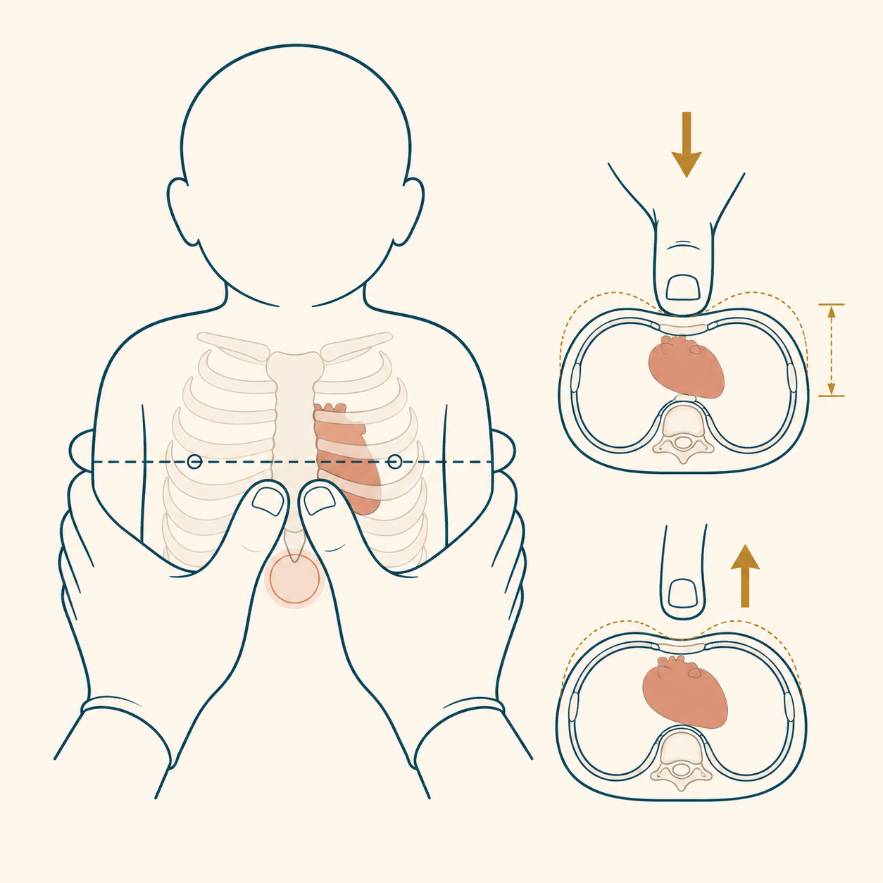 Tórax de recém-nascido em vista anterior com o coração atrás do terço inferior do esterno; dois polegares justapostos sobre esse ponto, abaixo da linha intermamilar, com os demais dedos envolvendo o dorso; apêndice xifoide destacado logo abaixo dos polegares e vista lateral mostrando a profundidade de um terço do diâmetro anteroposterior e a reexpansão do tórax.