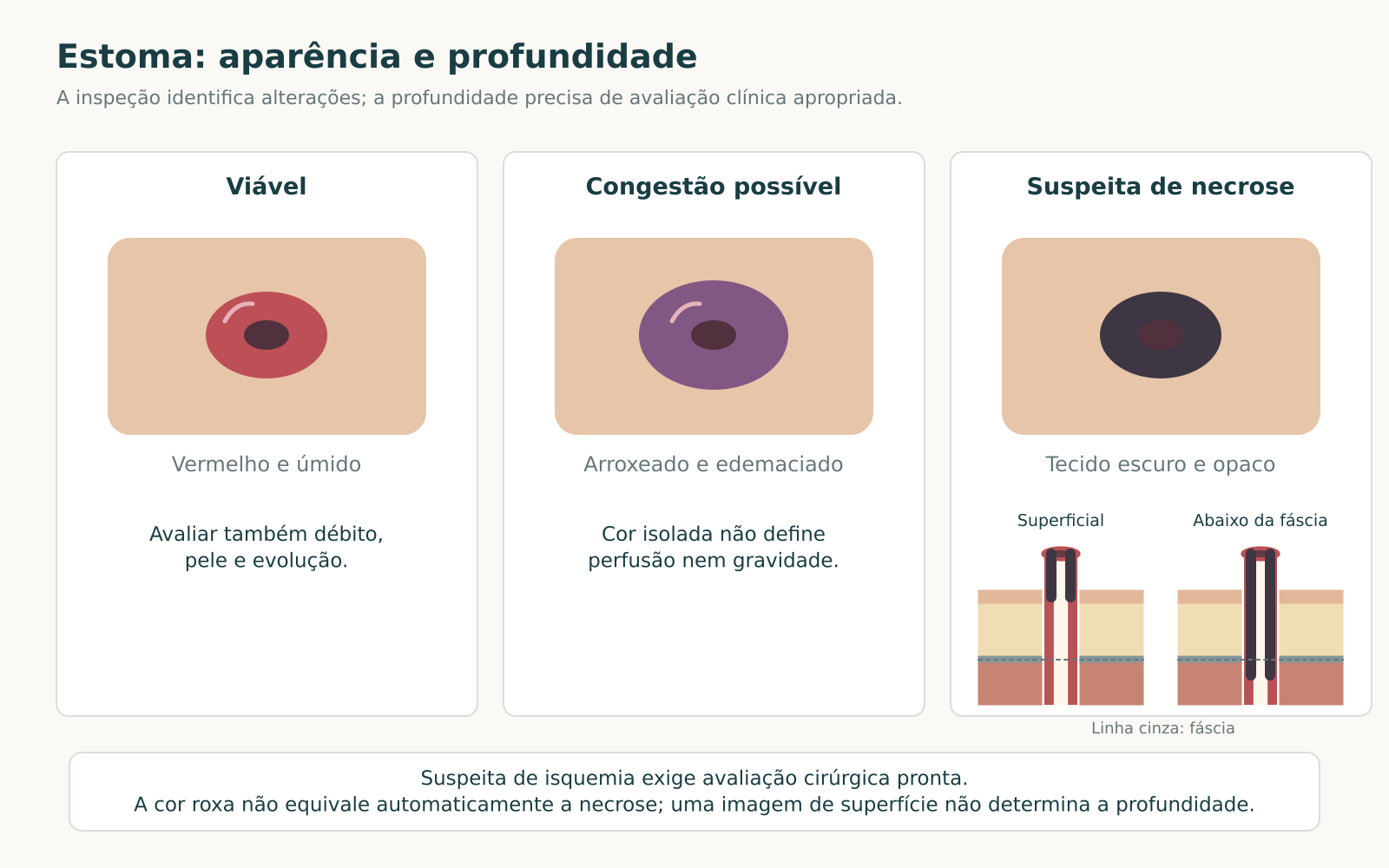 Comparação esquemática de estoma viável, possível congestão e suspeita de necrose, com dois cortes mostrando extensão superficial ou abaixo da fáscia.