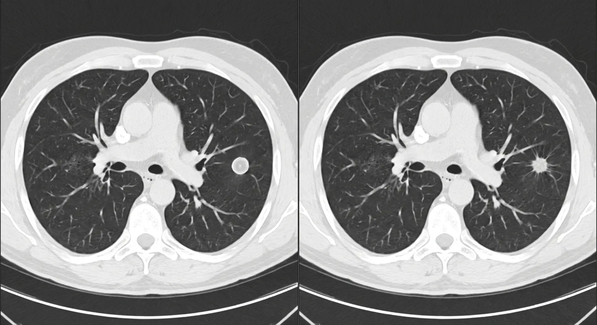 Dois cortes axiais de tomografia de tórax: pequeno nódulo liso com calcificação central e pequeno nódulo não calcificado de margens espiculadas.