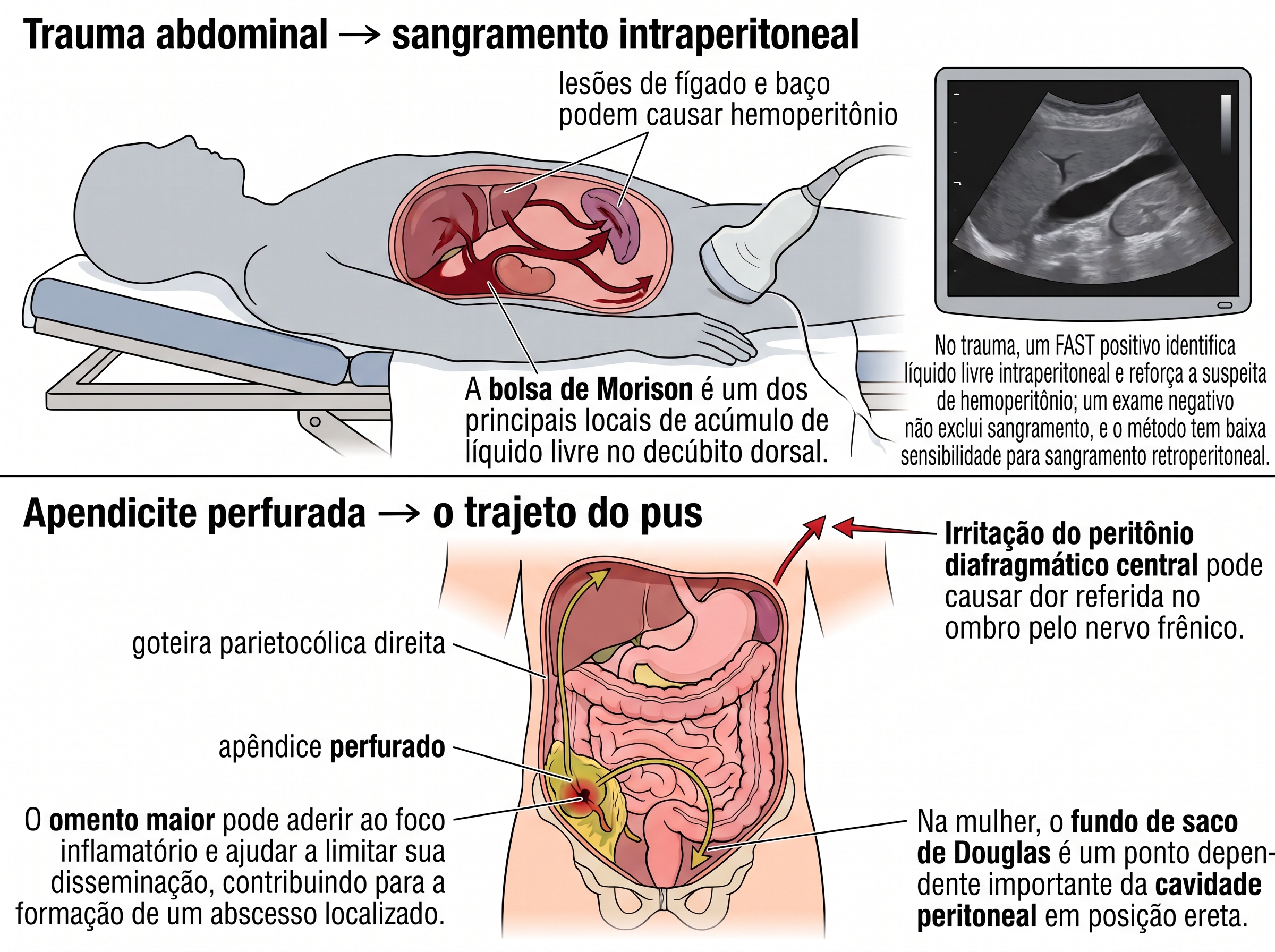 Paciente deitado com sangue acumulando em Morison sob o ultrassom, e mapa frontal das estradas do pus da fossa ilíaca direita ao subfrênico e ao fundo de saco de Douglas.